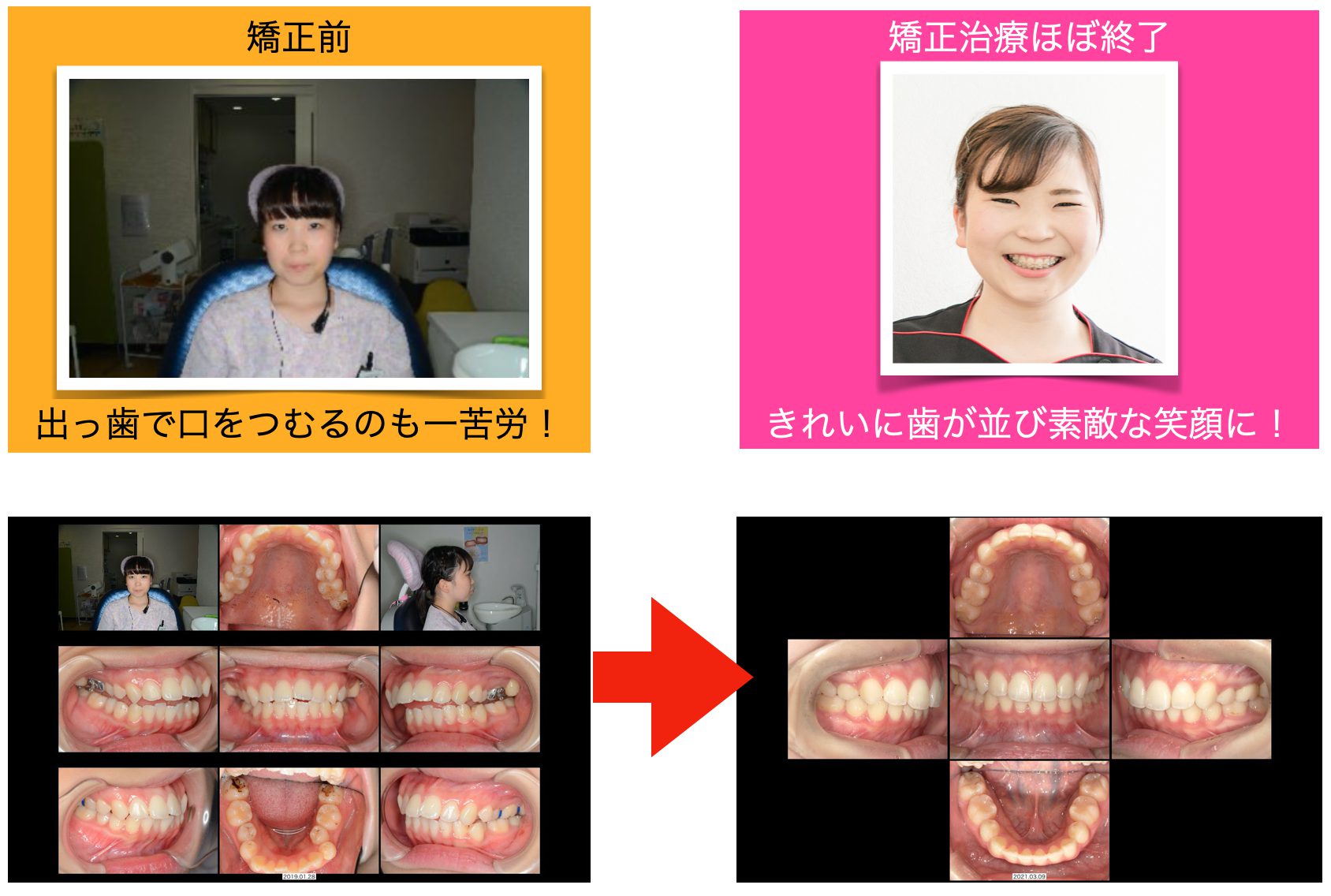 歯列矯正で美人になった人の共通点と劇的変化の真相【2026年最新】