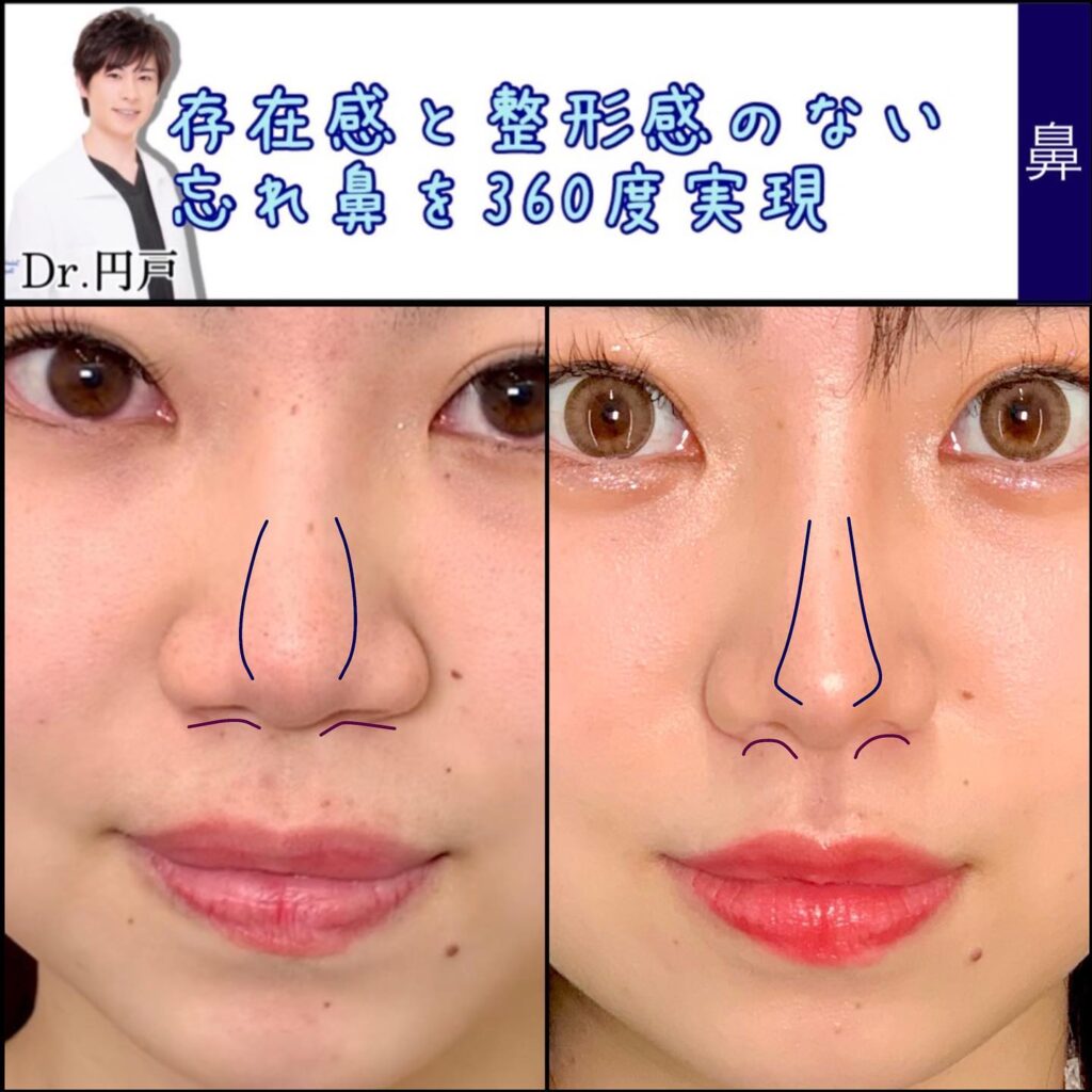 鼻を小さくする決定打！自力マッサージの真偽と2026年最新美容医療