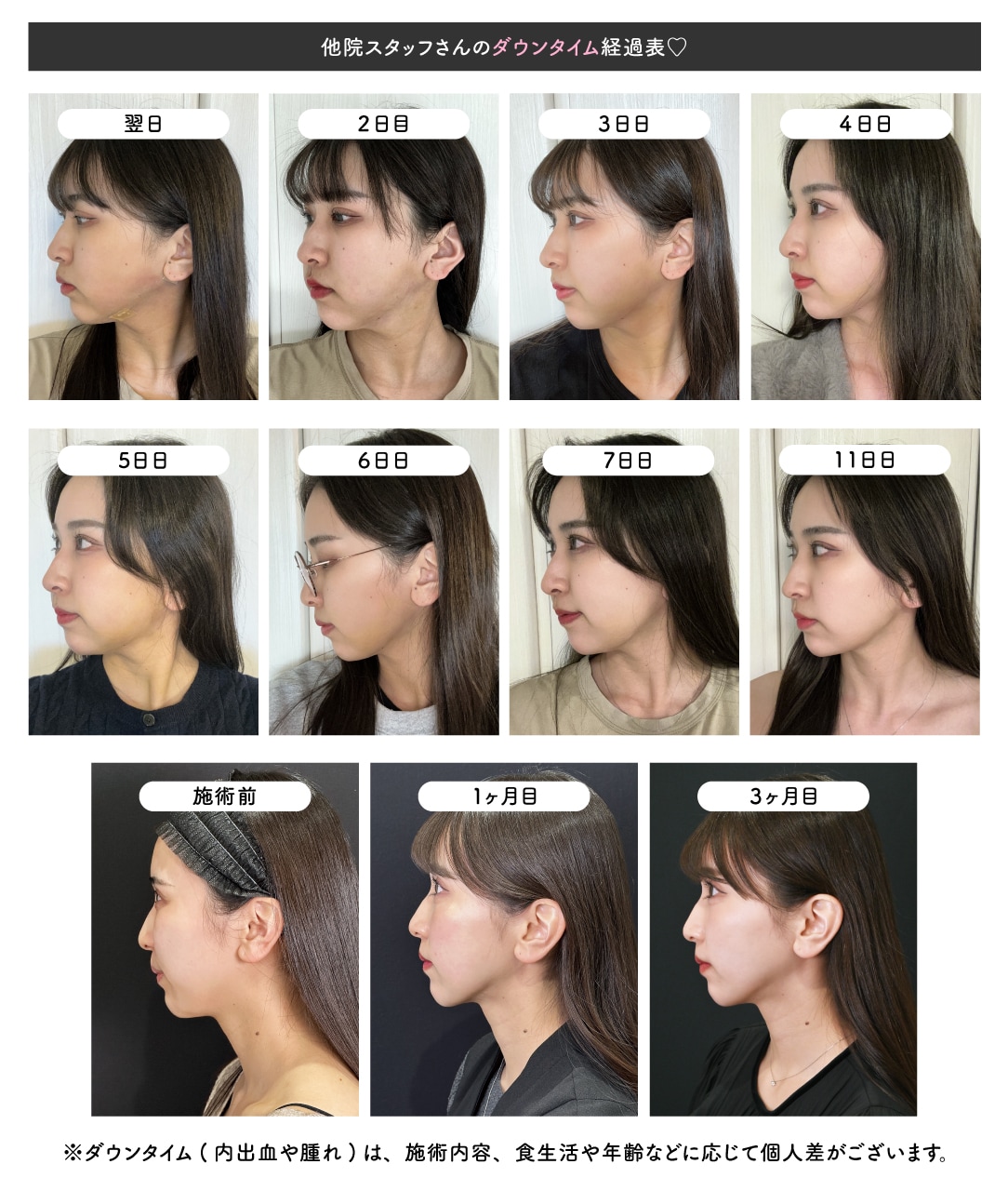 顔の脂肪吸引ダウンタイム徹底調査｜腫れピークとバレない仕事復帰術