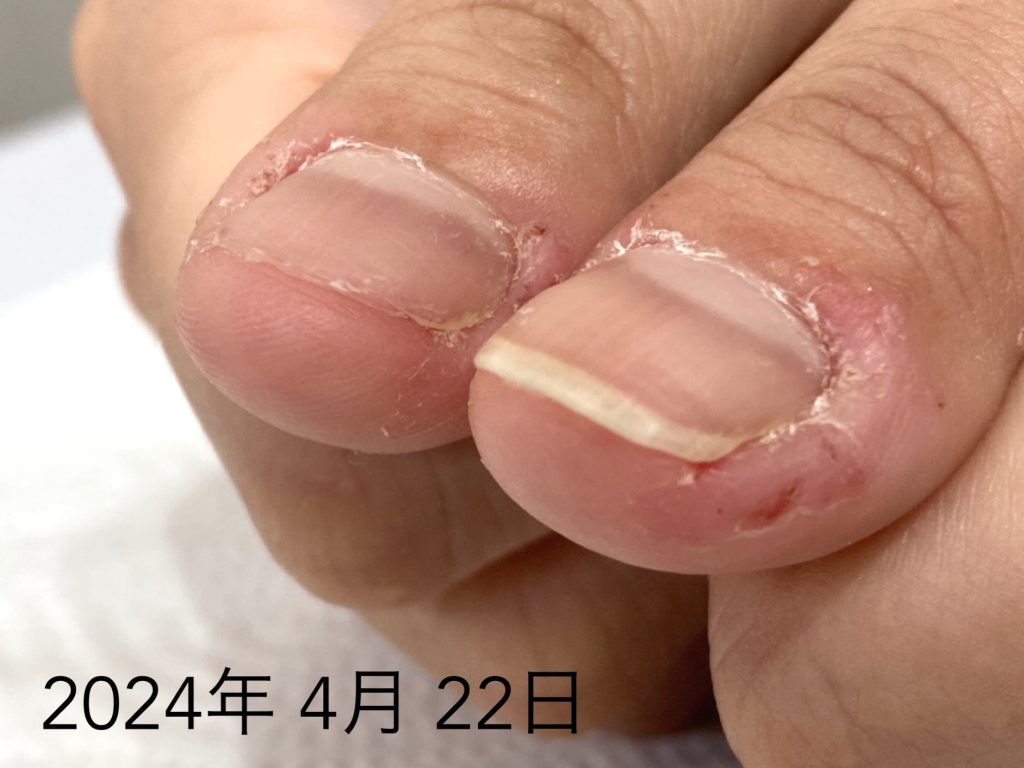 皮膚むしり症の罠｜指の皮を剥く原因と自力で治す2026年の新常識