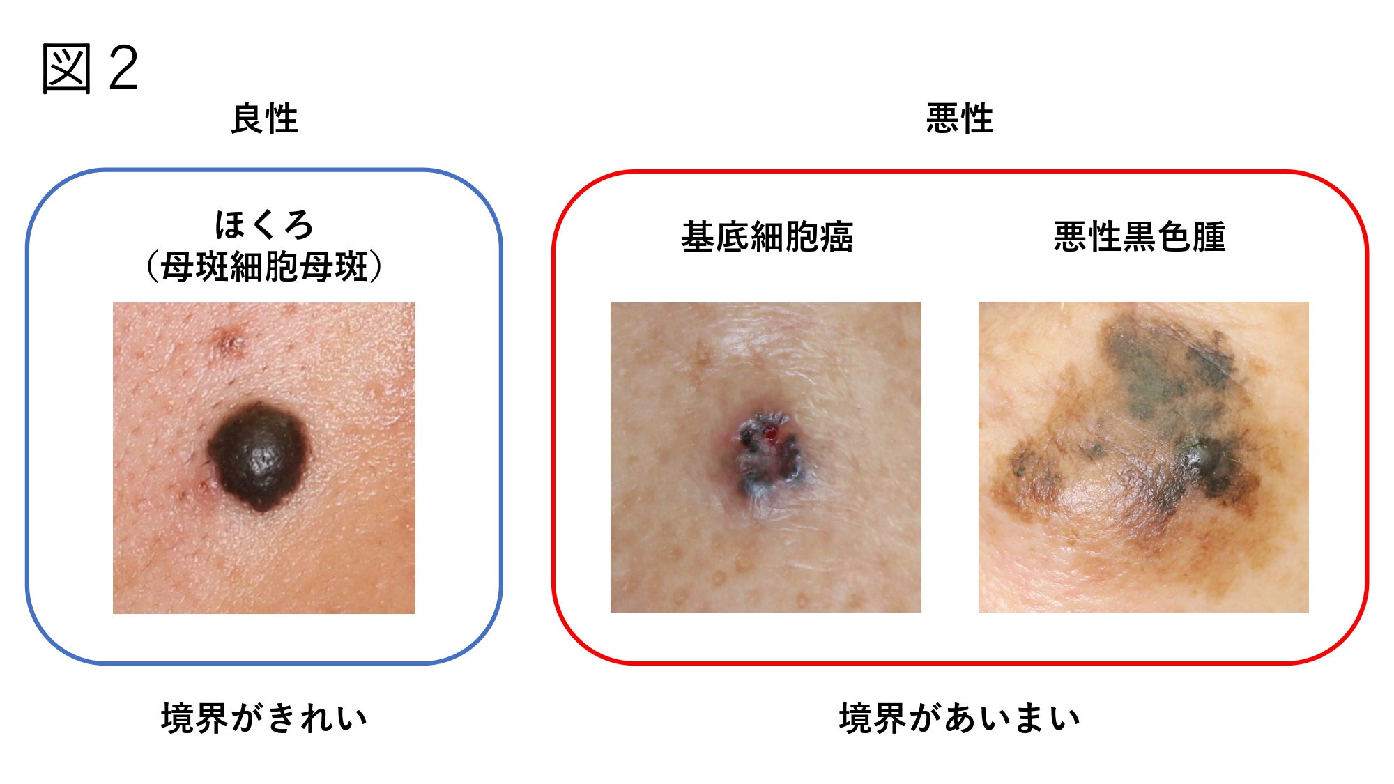 ほくろ除去の失敗原因と後悔を防ぐ全知識【2026年最新】