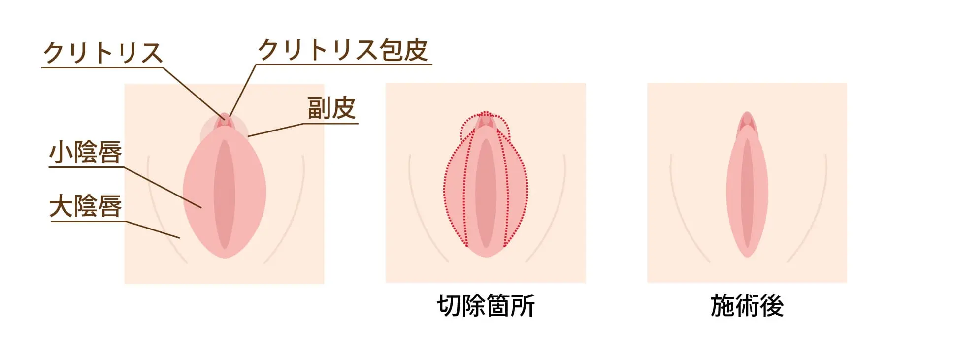 恥垢（ちこう）とは？白いカスの正体と臭い・痒みを防ぐ正しい落とし方