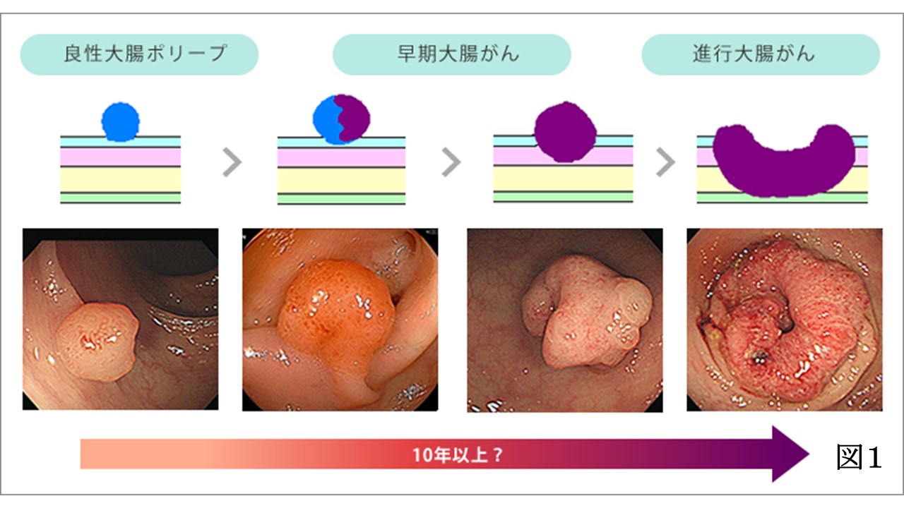 大腸ポリープ悪性画像の特徴とは？良性との違いと内視鏡写真の判別基準