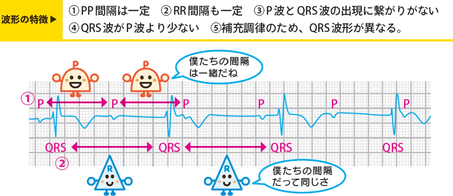 突然のめまい・失神は命の警告？完全房室ブロックの症状と最新治療