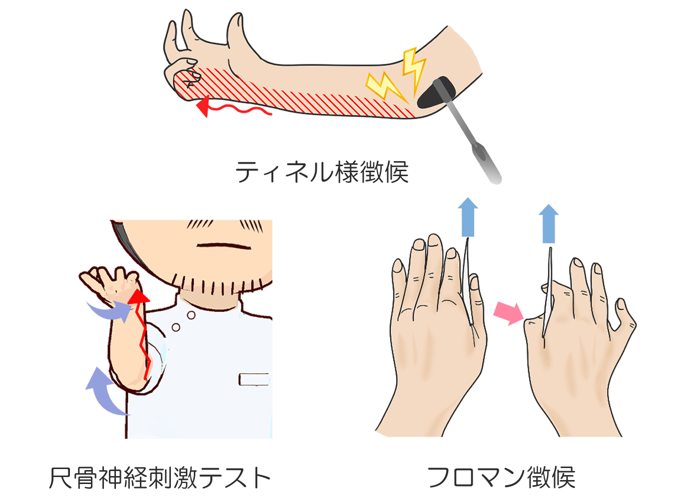 スマホ操作で小指・薬指がしびれる原因は？肘部管症候群のサインと改善策