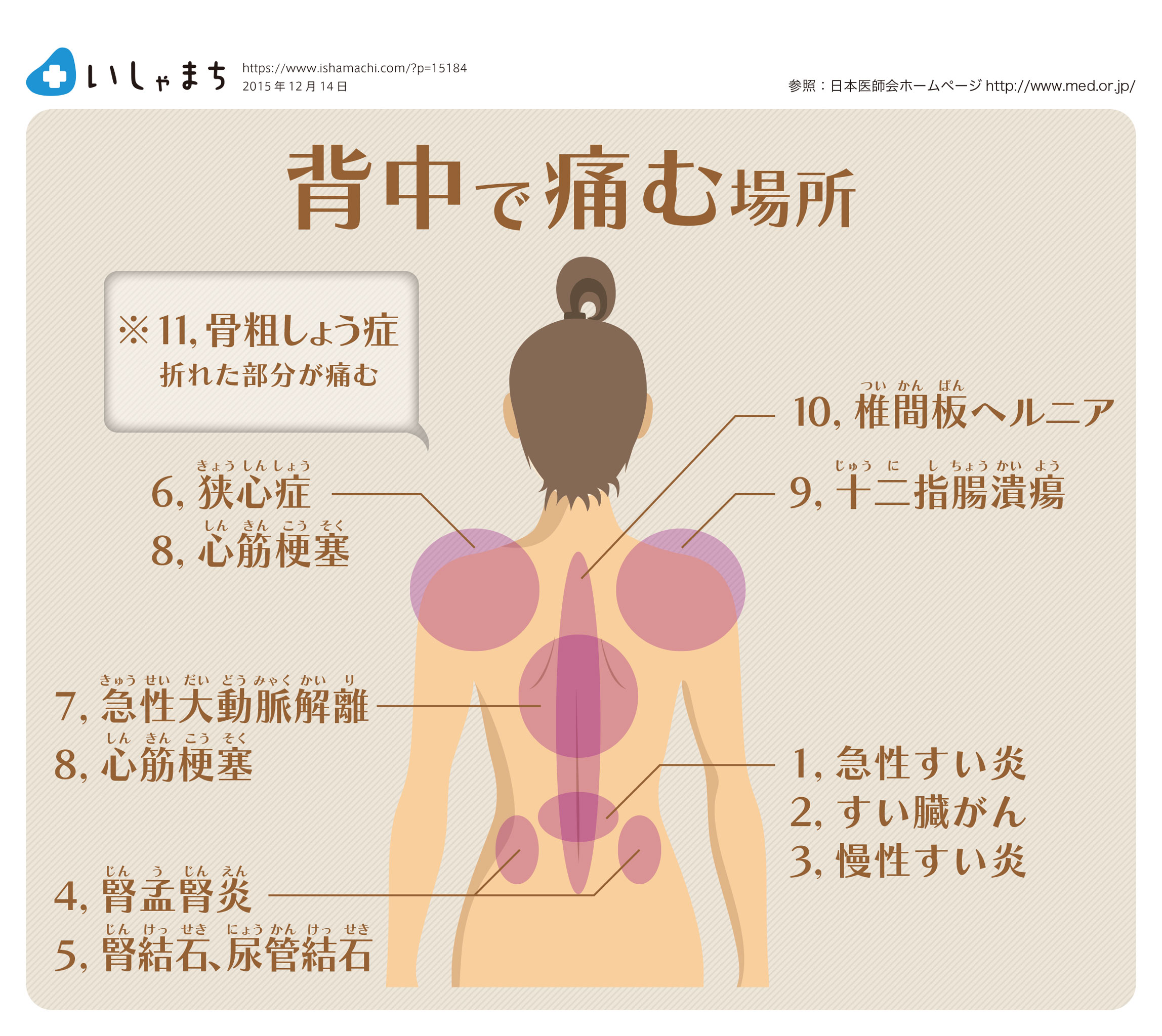 膵臓がんの背中の痛みとは？腰痛との違いと見逃せない前兆サイン