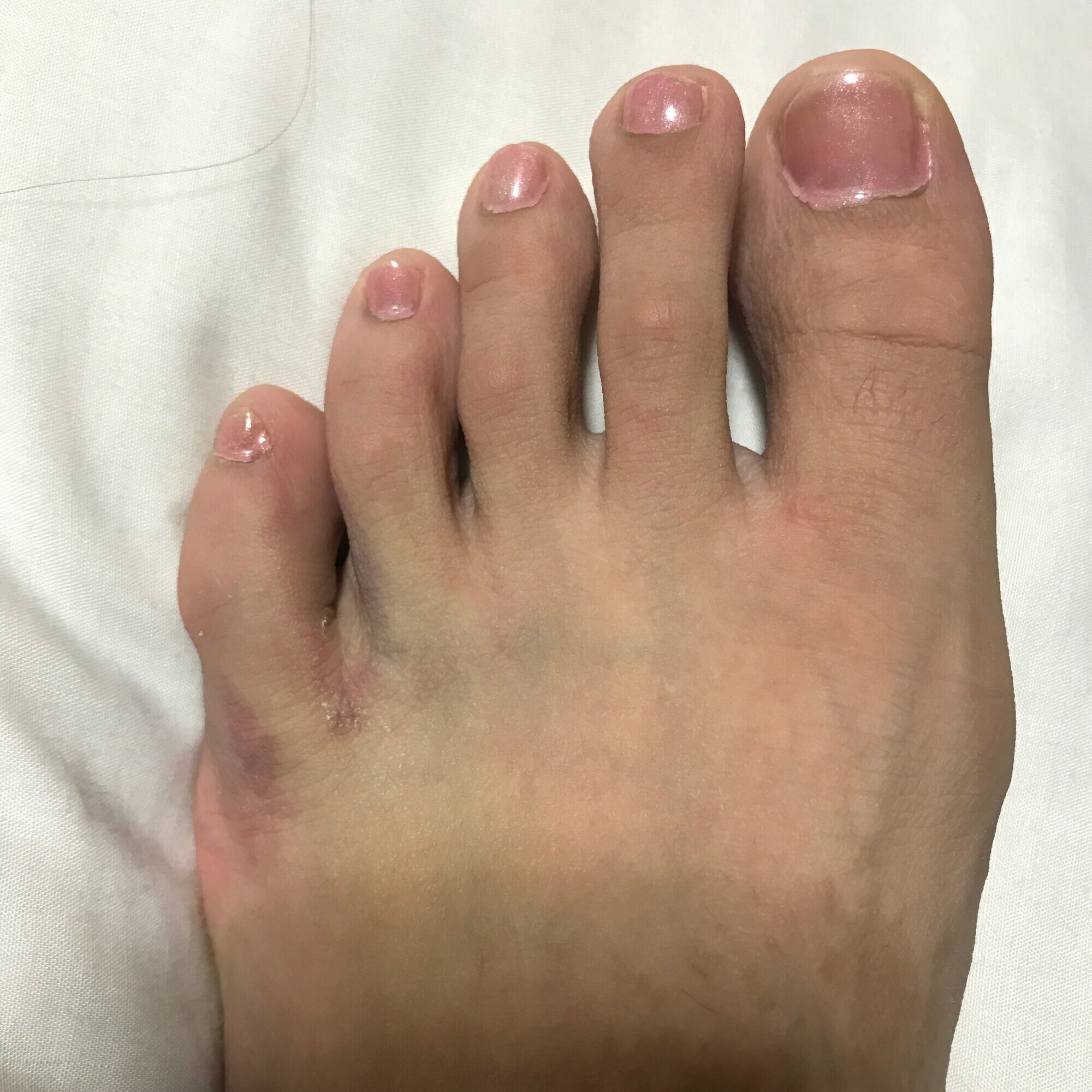 足の小指をぶつけた激痛は骨折？打撲との見分け方と応急処置を解説