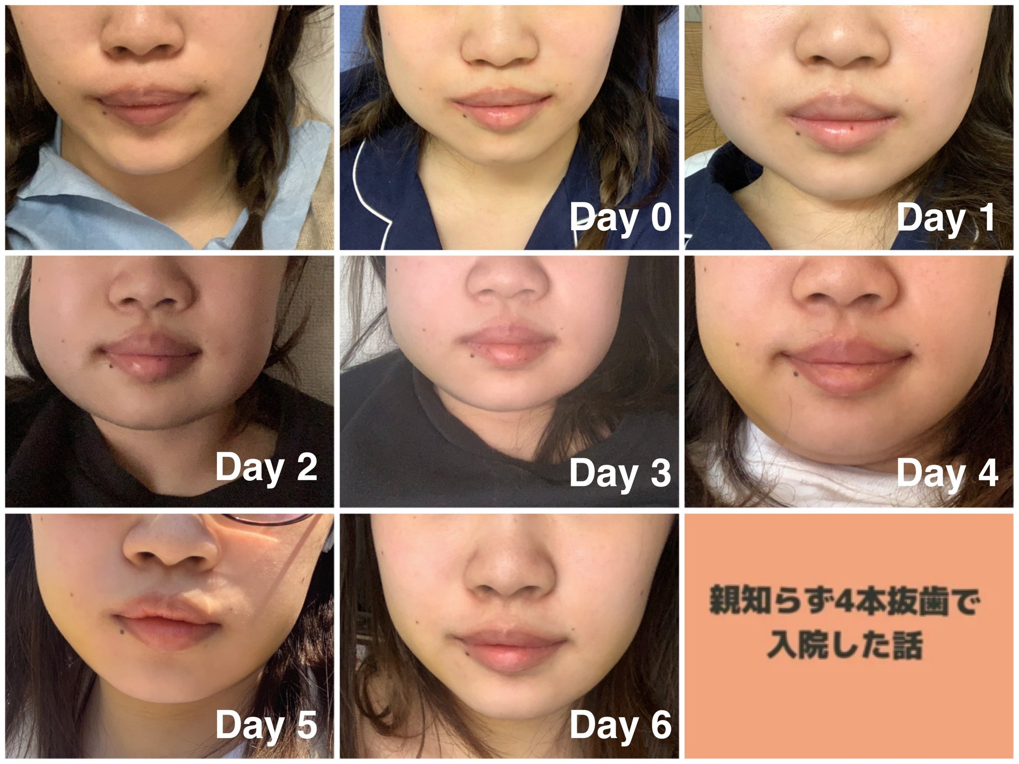 親知らず4本同時抜歯の真実！全身麻酔入院の費用と術後のリアル体験談