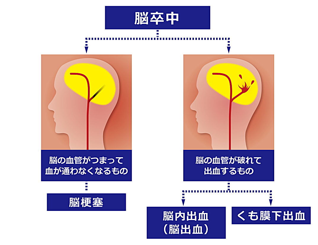 脳卒中と脳梗塞の違いとは？命を救う前兆と2026年最新治療の真実