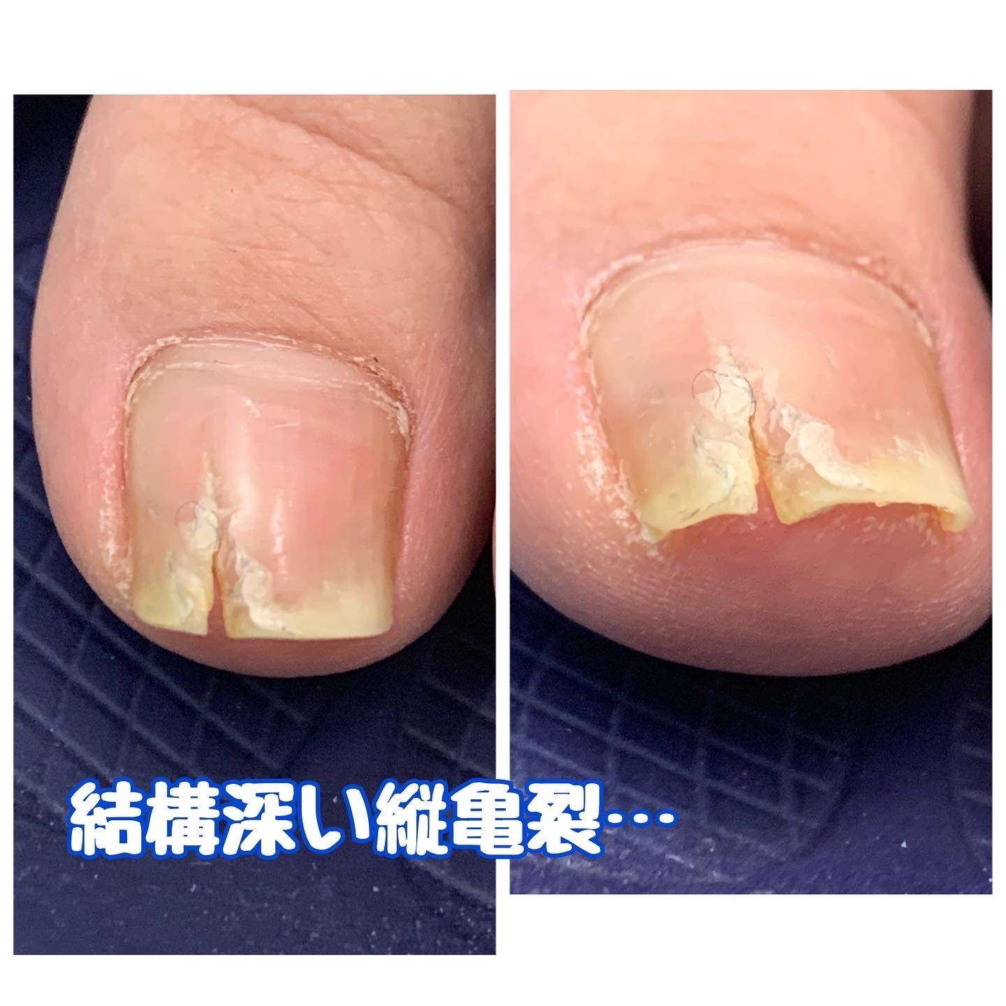 爪の縦割れはなぜ起きる？病気のサインから正しい治し方まで徹底検証