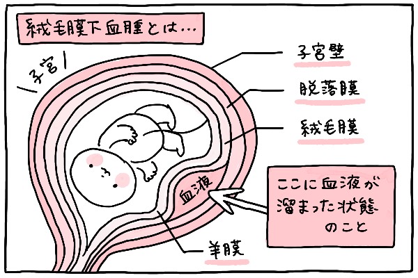 絨毛膜下血腫の出血はいつまで？流産確率と安静の真実【2026年最新】
