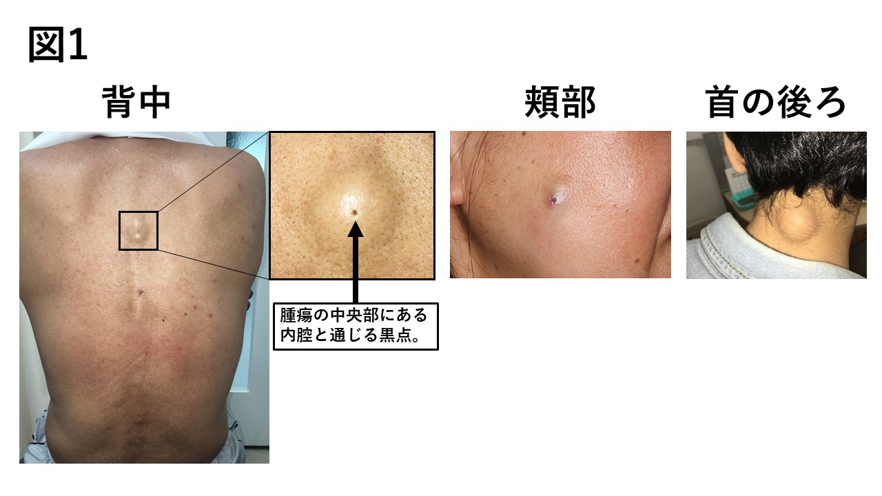粉瘤腫を自力で潰すと危険！専門医が警告する最新治療の真相