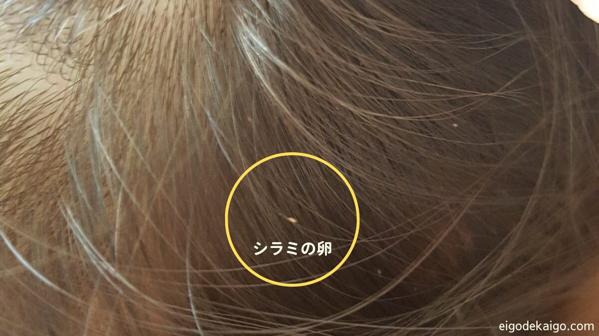 頭にシラミがいるかどうかの見分け方！フケとの違いや簡単チェック法