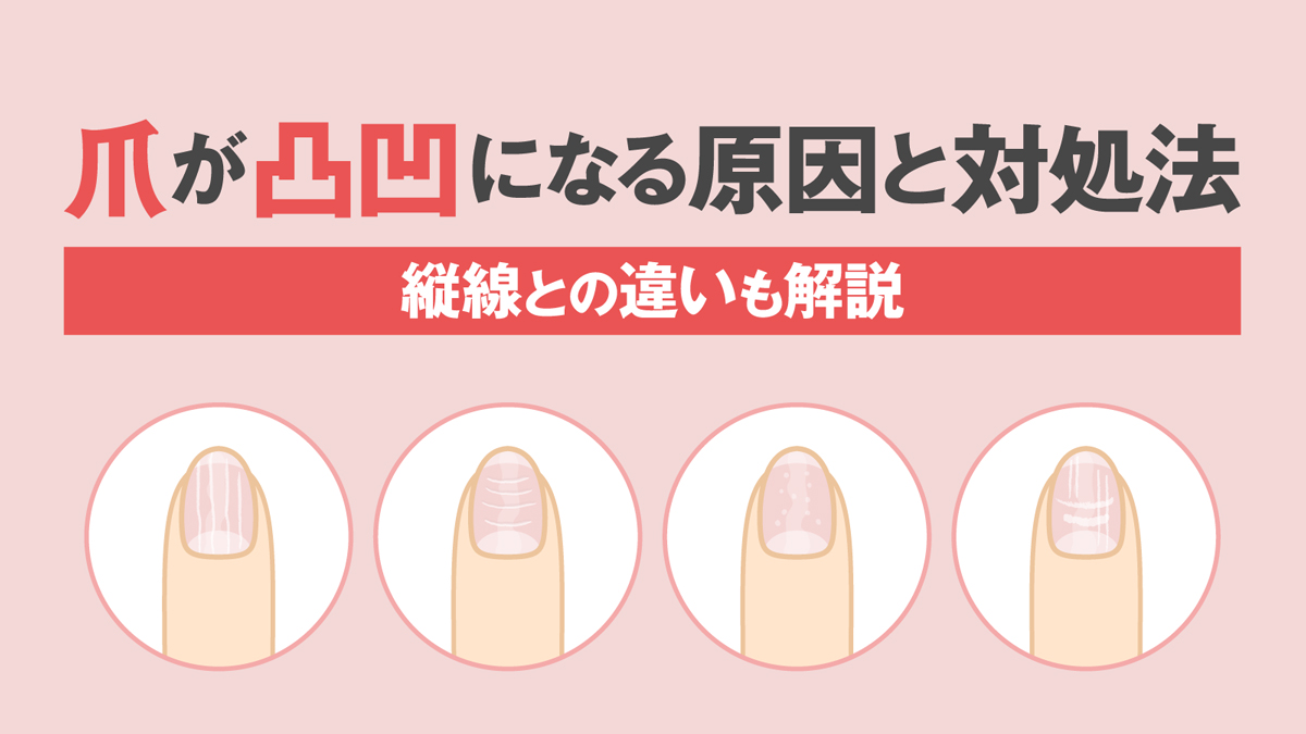 爪のでこぼこは病気のサイン？縦線・横線の原因と改善策を徹底解説