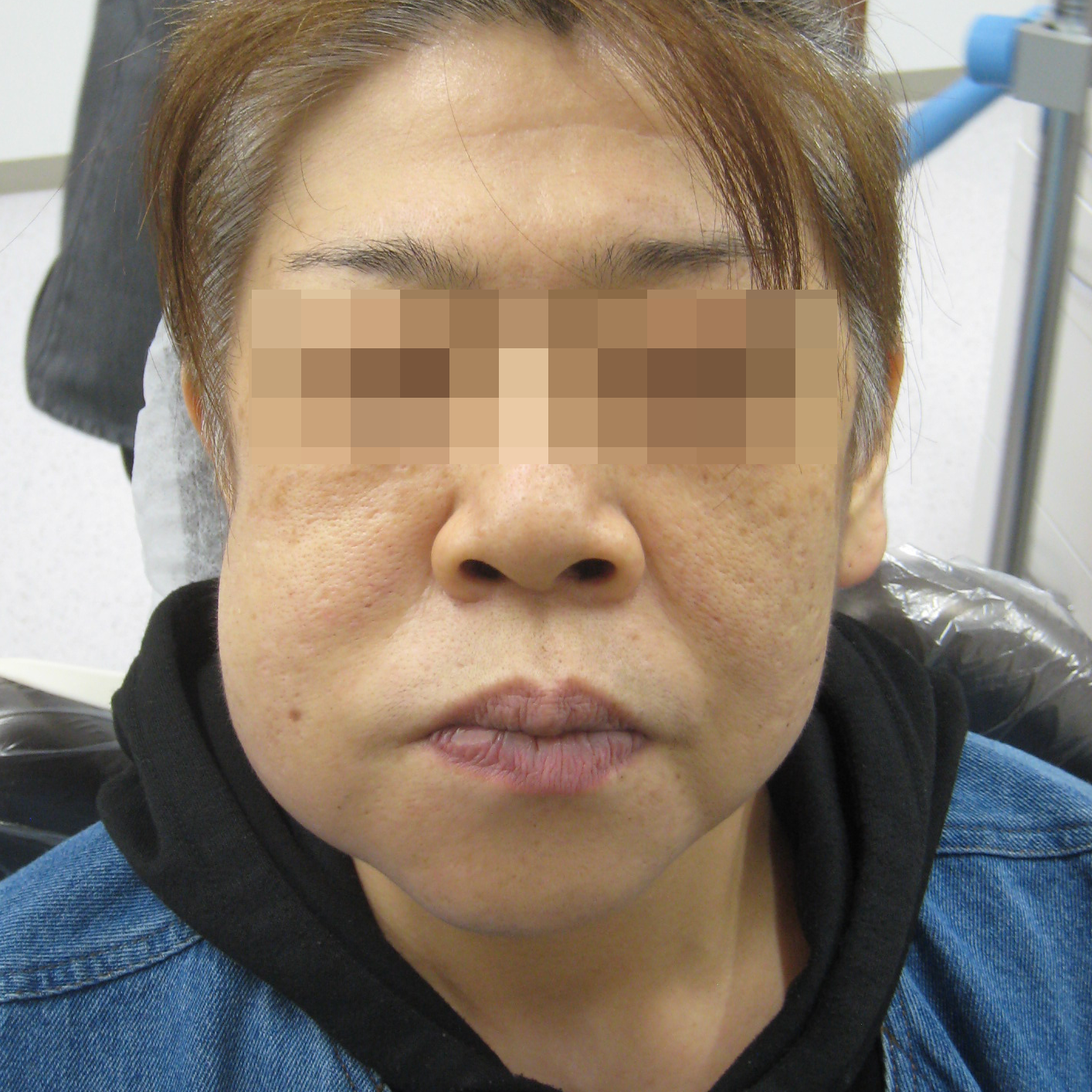 虫歯で顔が腫れる原因とは？放置の危険性と正しい応急処置を徹底解説