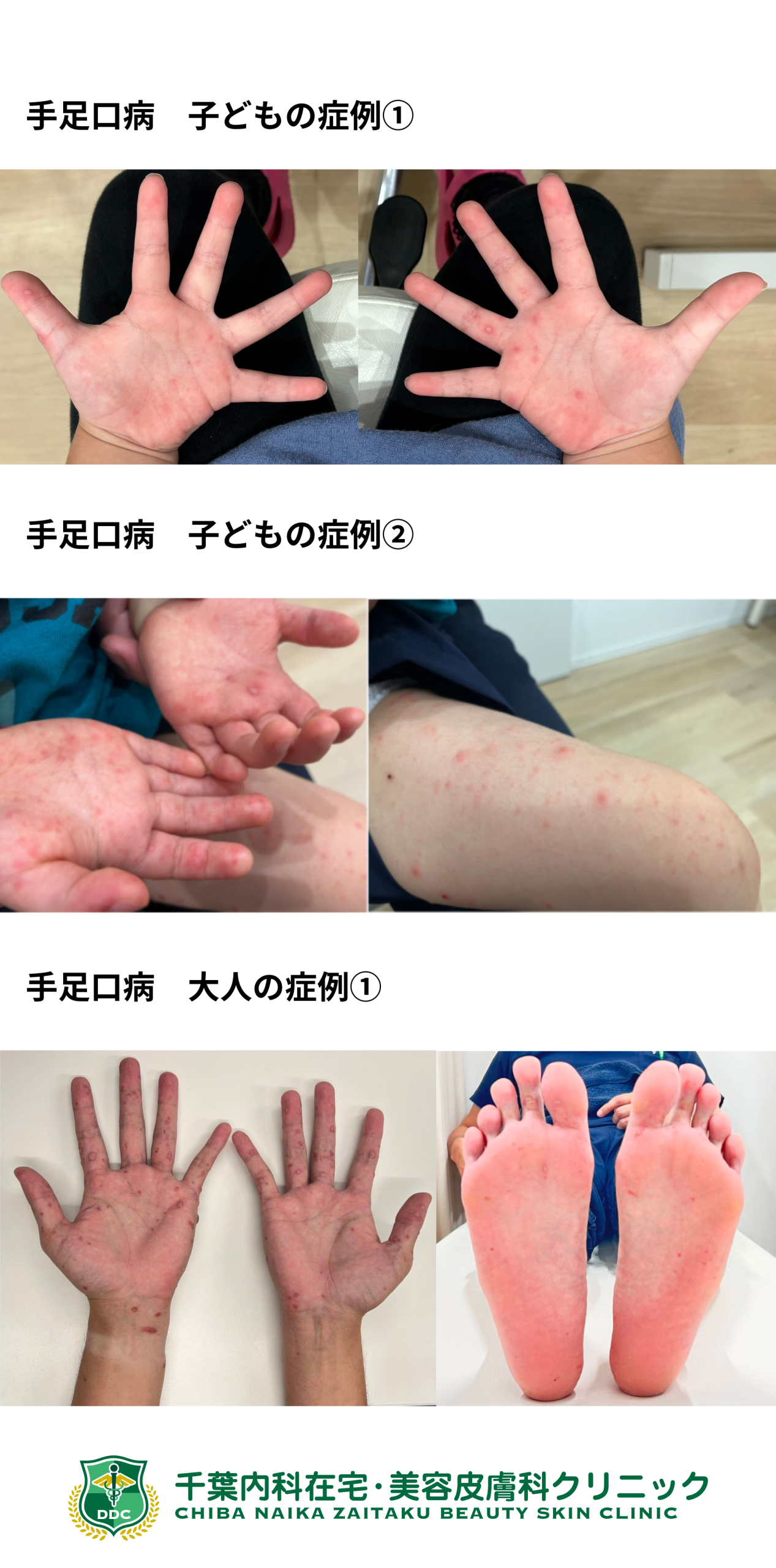 大人の手足口病はなぜ重症化？激痛発疹と爪剥がれの全経過