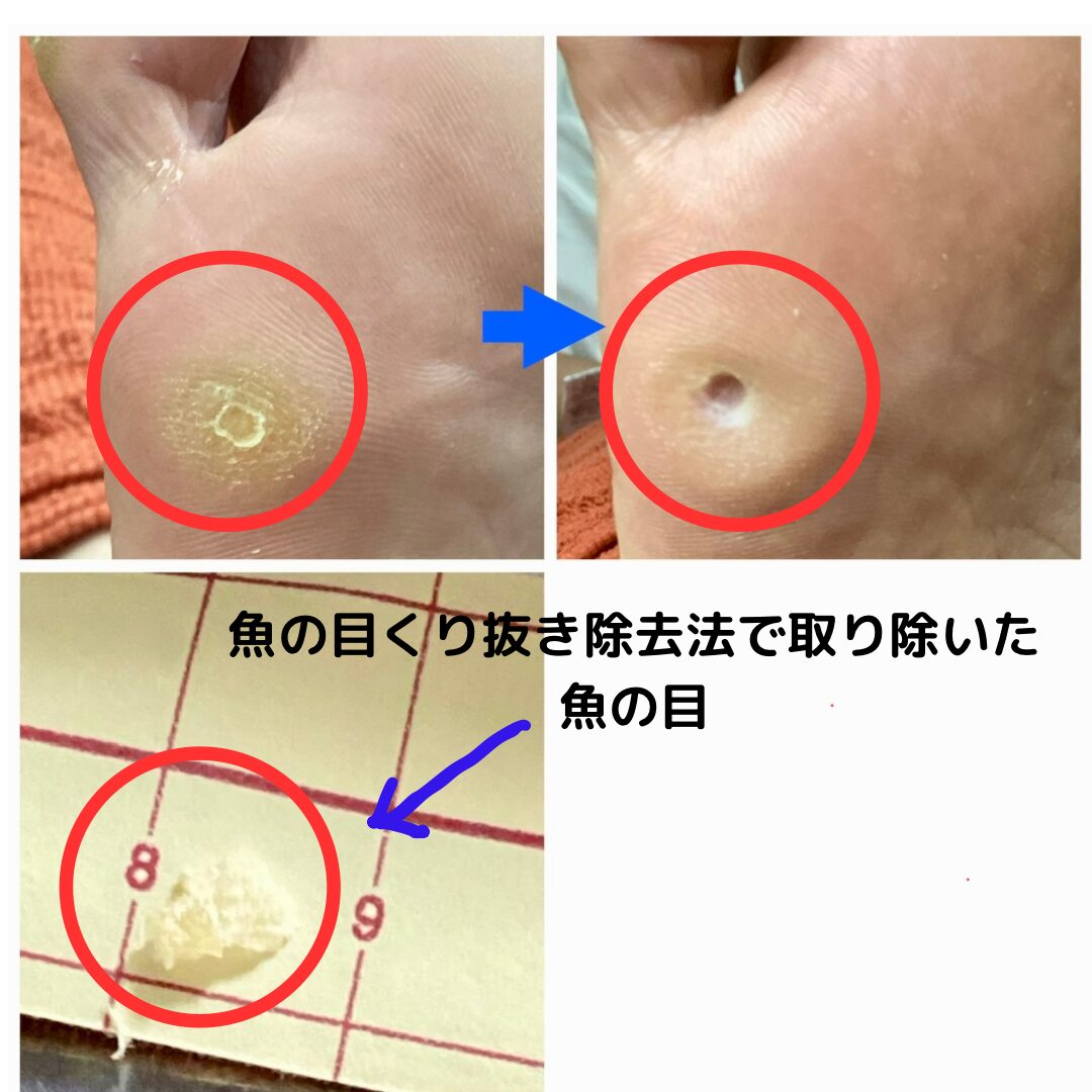 魚の目の芯を引っこ抜くのは危険？ピンセット除去の罠と正しい治し方