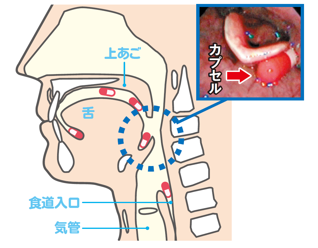 錠剤が喉に引っかかるのはなぜ？放置は危険な食道潰瘍も！対処法を徹底解説