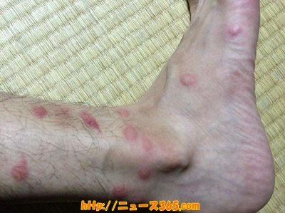 【徹底調査】 ノミ に 刺され た 跡 私服＆私生活最新ショット #617