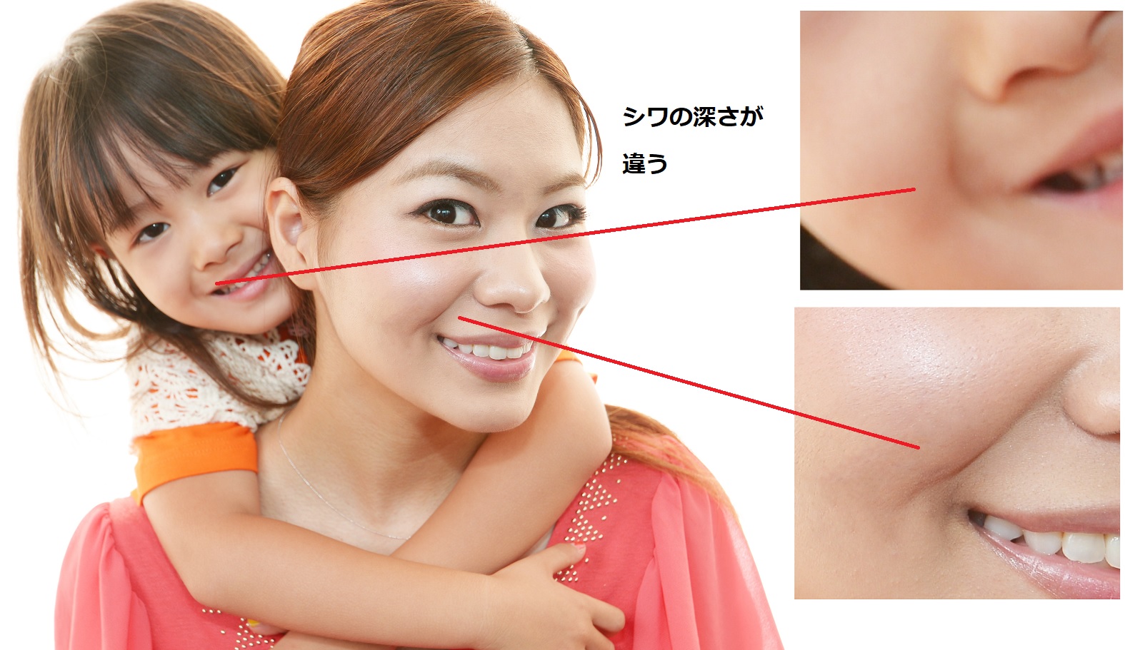 笑った時のほうれい線が戻らない原因は？定着を防ぐ最新改善策を徹底解説