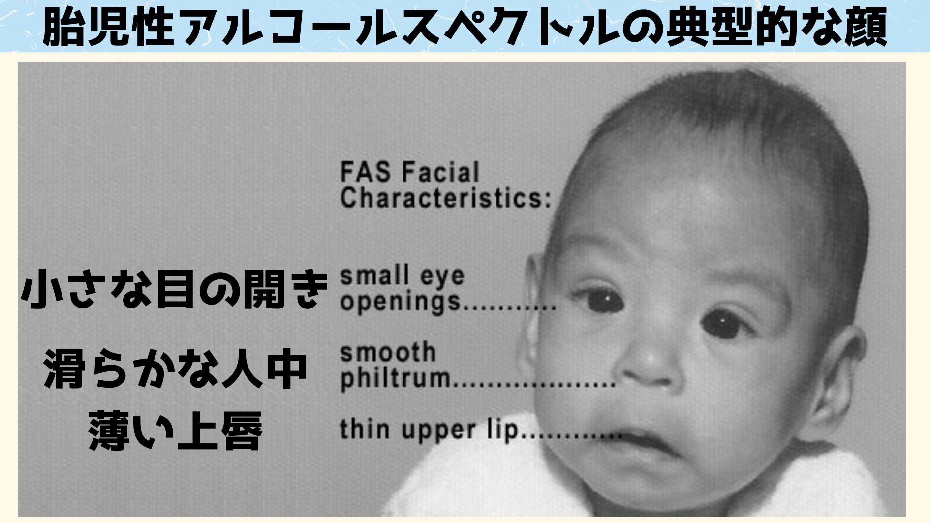 胎児性アルコール症候群の真実｜症状と予防の決定版ガイド