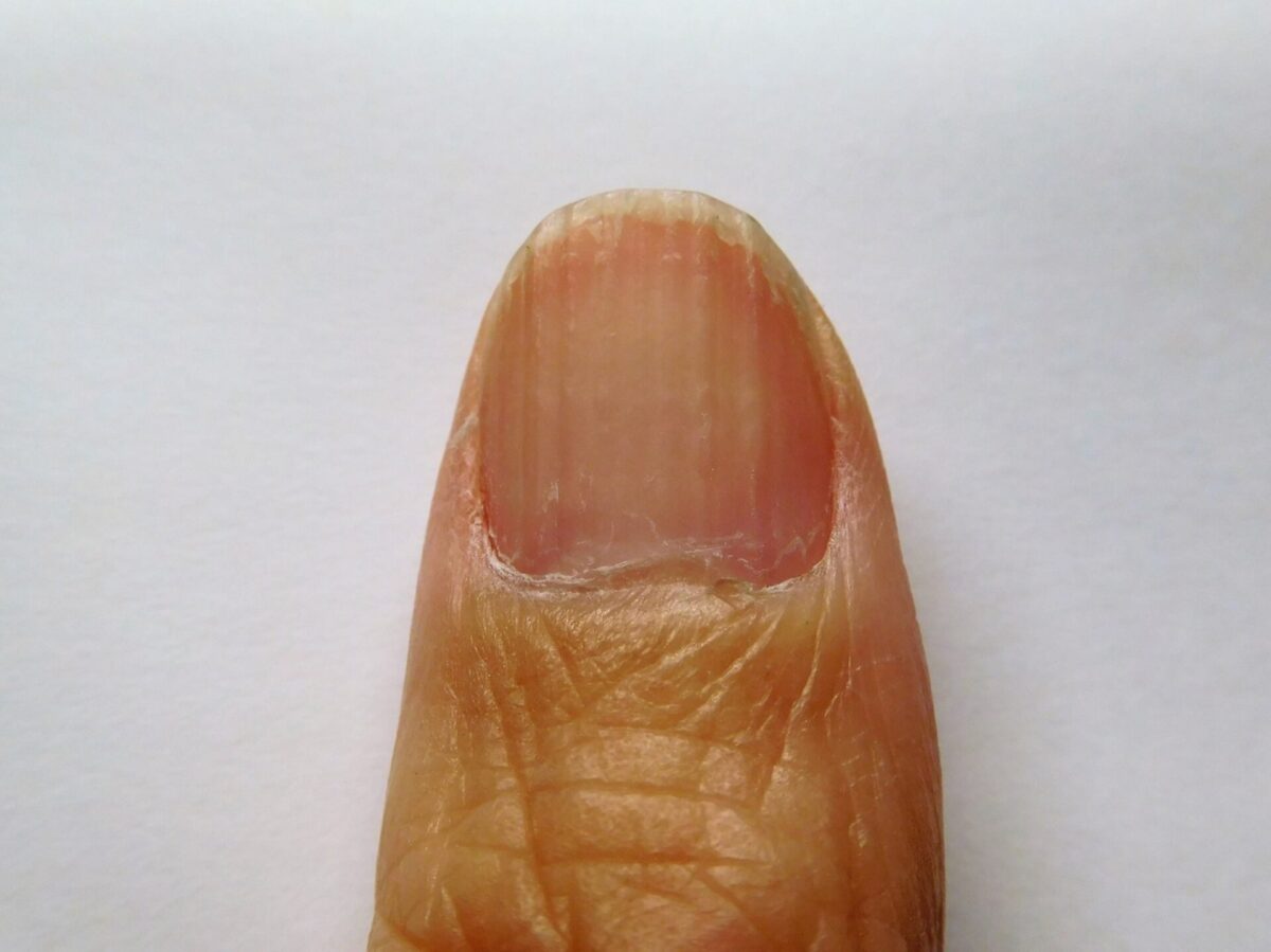 爪の縦線ができる本当の原因とは？危険な病気の見分け方と改善策