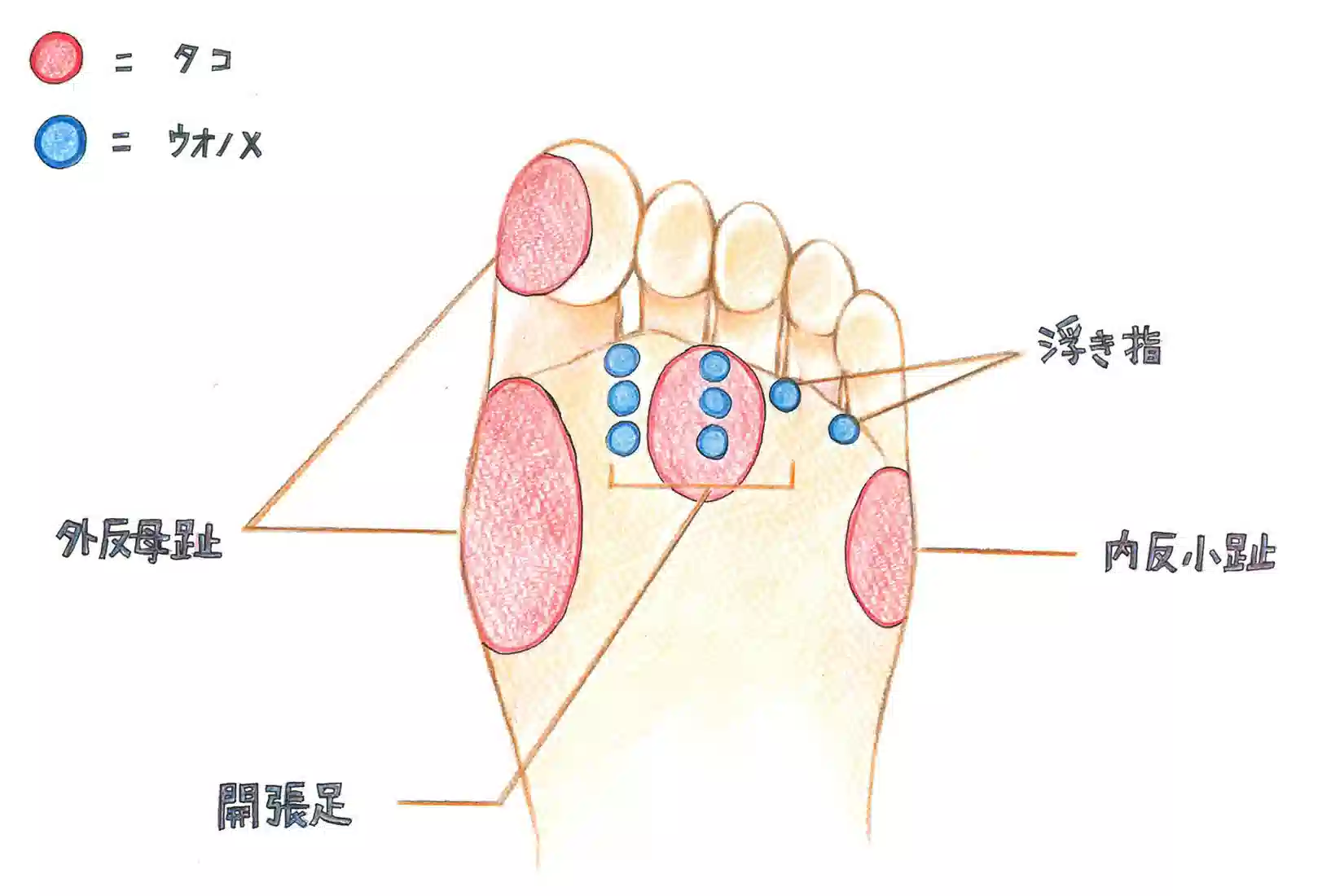 足裏のタコは場所で原因が違う！骨の歪みと痛みの正体を徹底解明