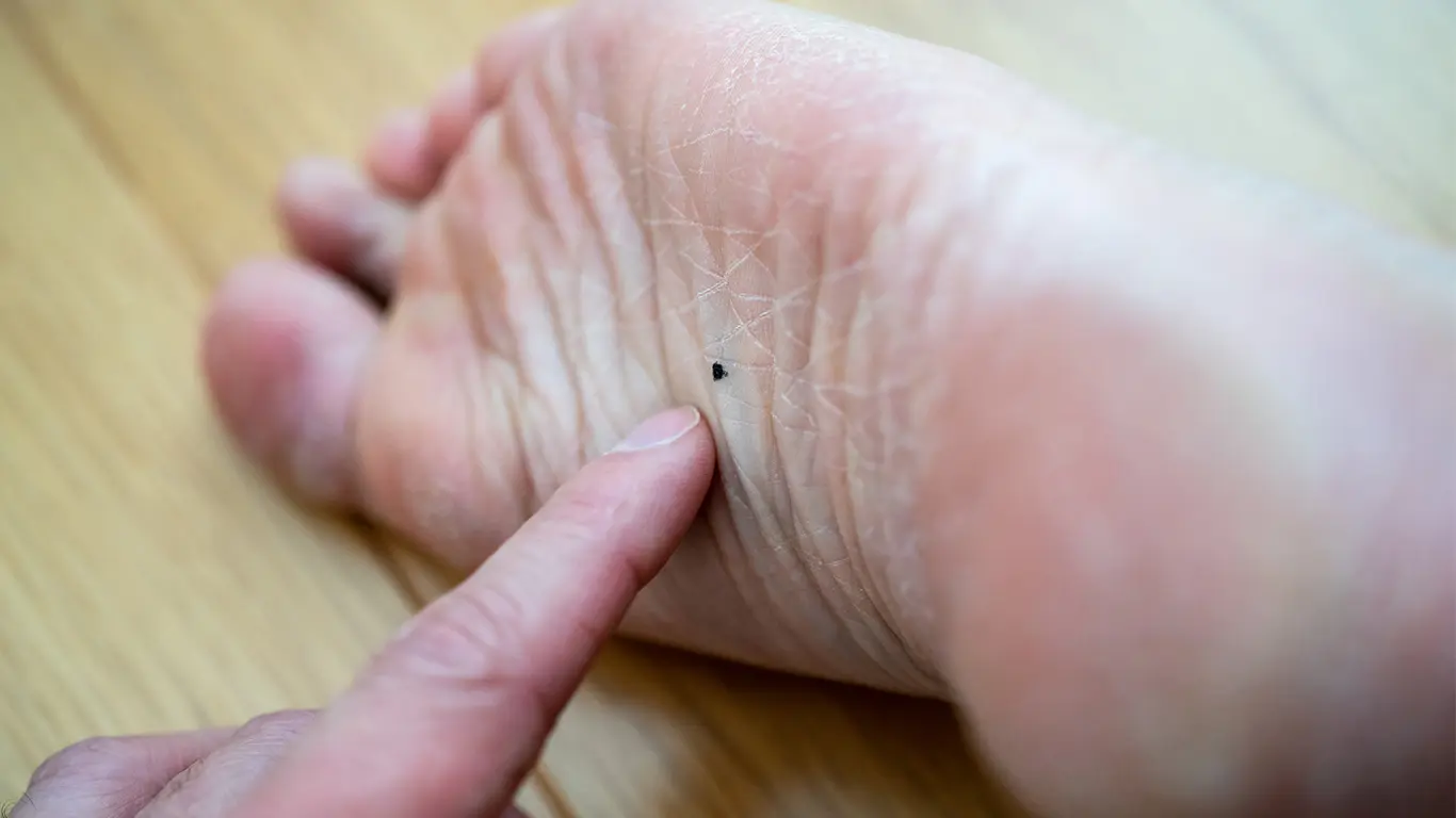 手のひらのほくろは癌？悪性黒色腫の見分け方と危険サイン【2026】