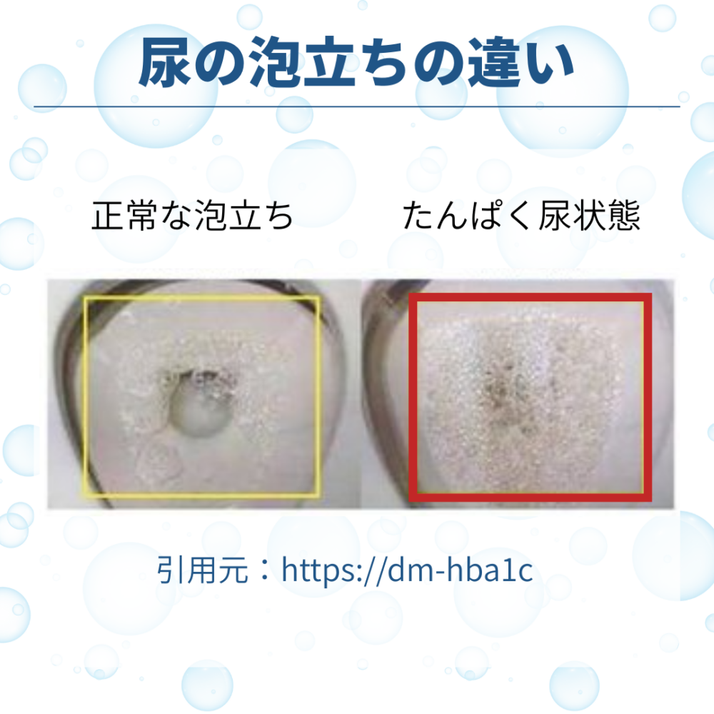 おしっこの泡立ちは病気のサイン？危険な泡の見分け方と放置リスク