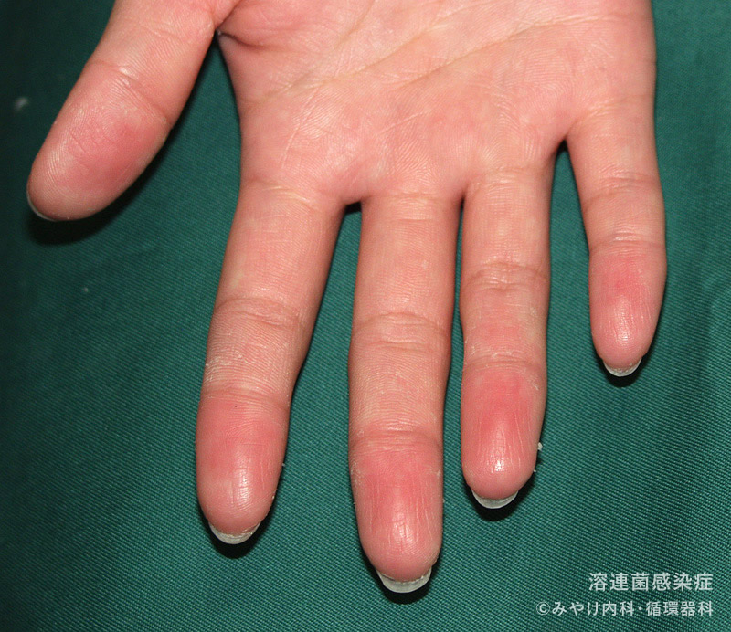 指先の絆創膏が剥がれない貼り方！ハサミの切り込み裏ワザを徹底解説