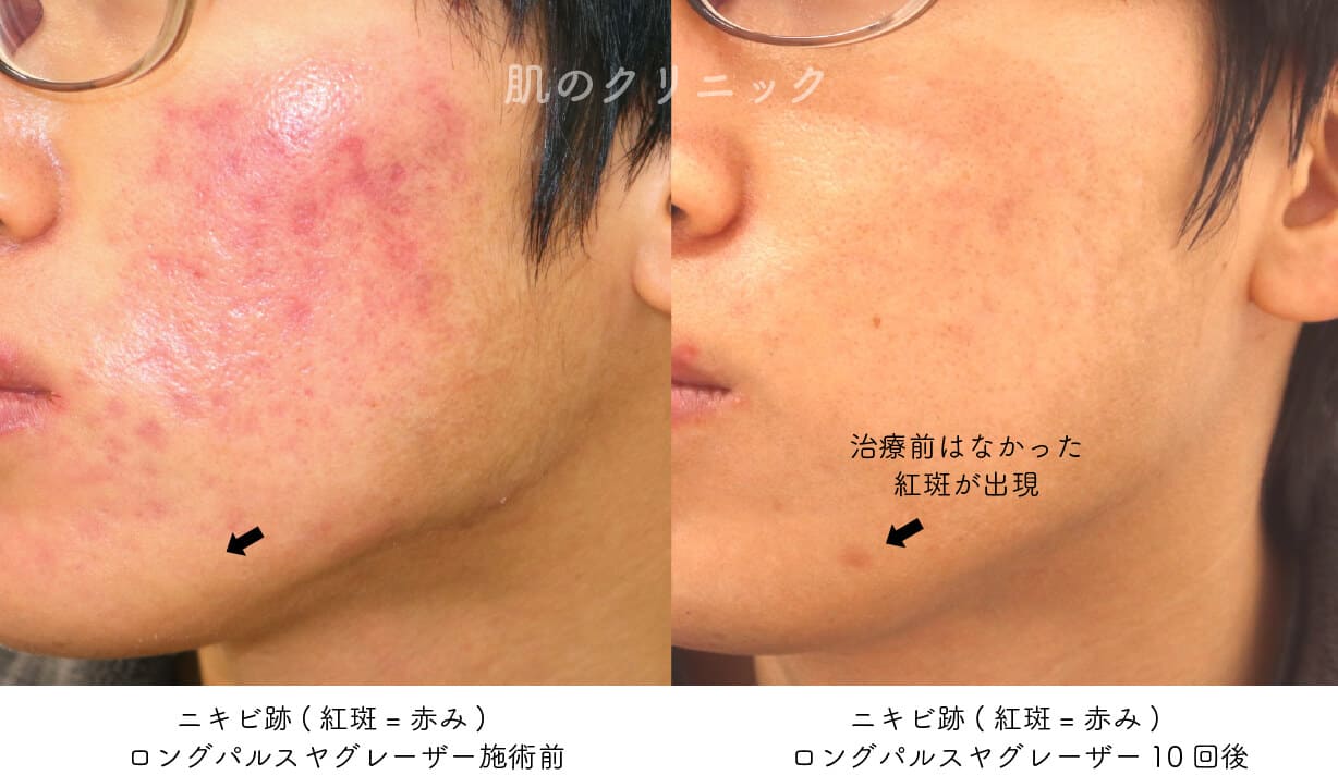 消えないニキビ跡の赤みを治す！皮膚科治療と2026年最新ケア