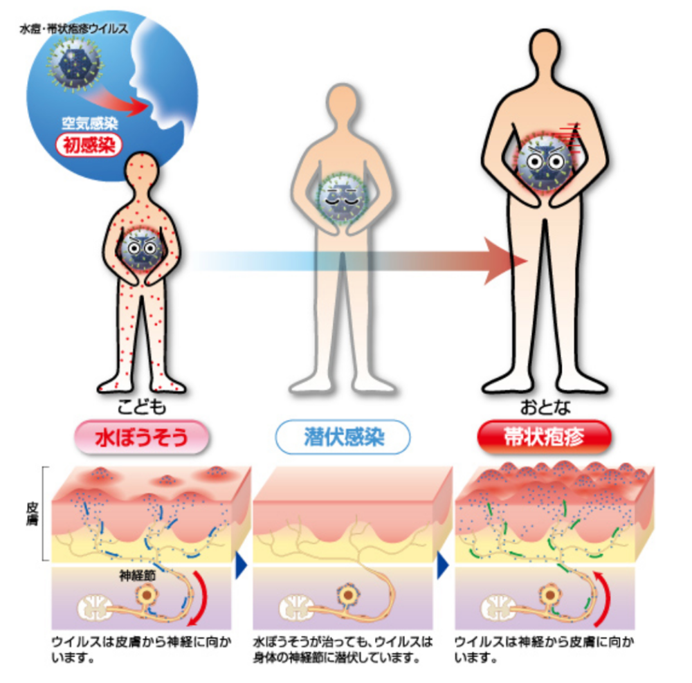 水疱瘡と帯状疱疹は何が違う？初期症状・うつる仕組みと最新予防策