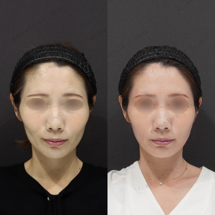 頬こけヒアルロン酸のデメリットとは？たるみ悪化の真相と失敗回避の極意