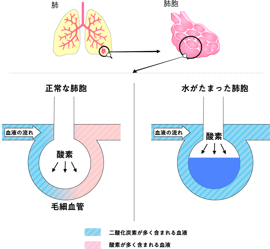 心不全で肺に水が溜まる原因とは？横になれない前兆と2026年の最新治療