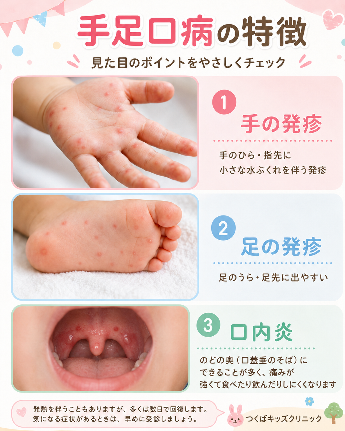 手足口病は新生児にうつる？上の子の感染対策と重症化サイン・受診目安