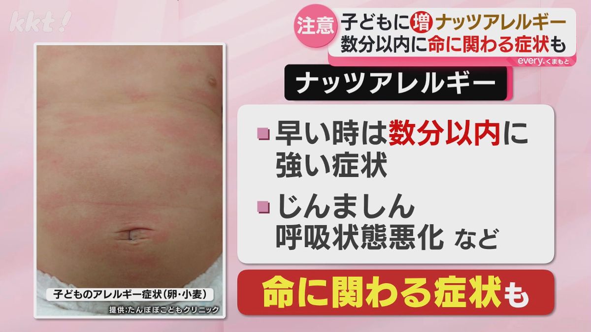 ナッツアレルギーは治る？一生モノの噂と2026年最新治療の真実
