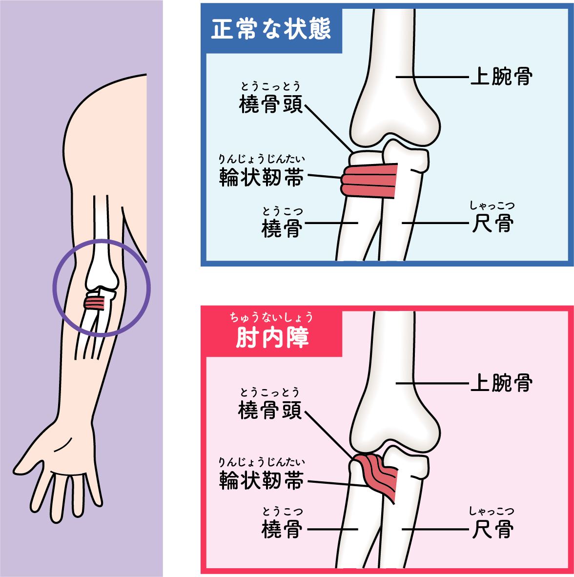 突然腕を動かさない子供…肘内障の治し方と骨折との見分け方・受診目安