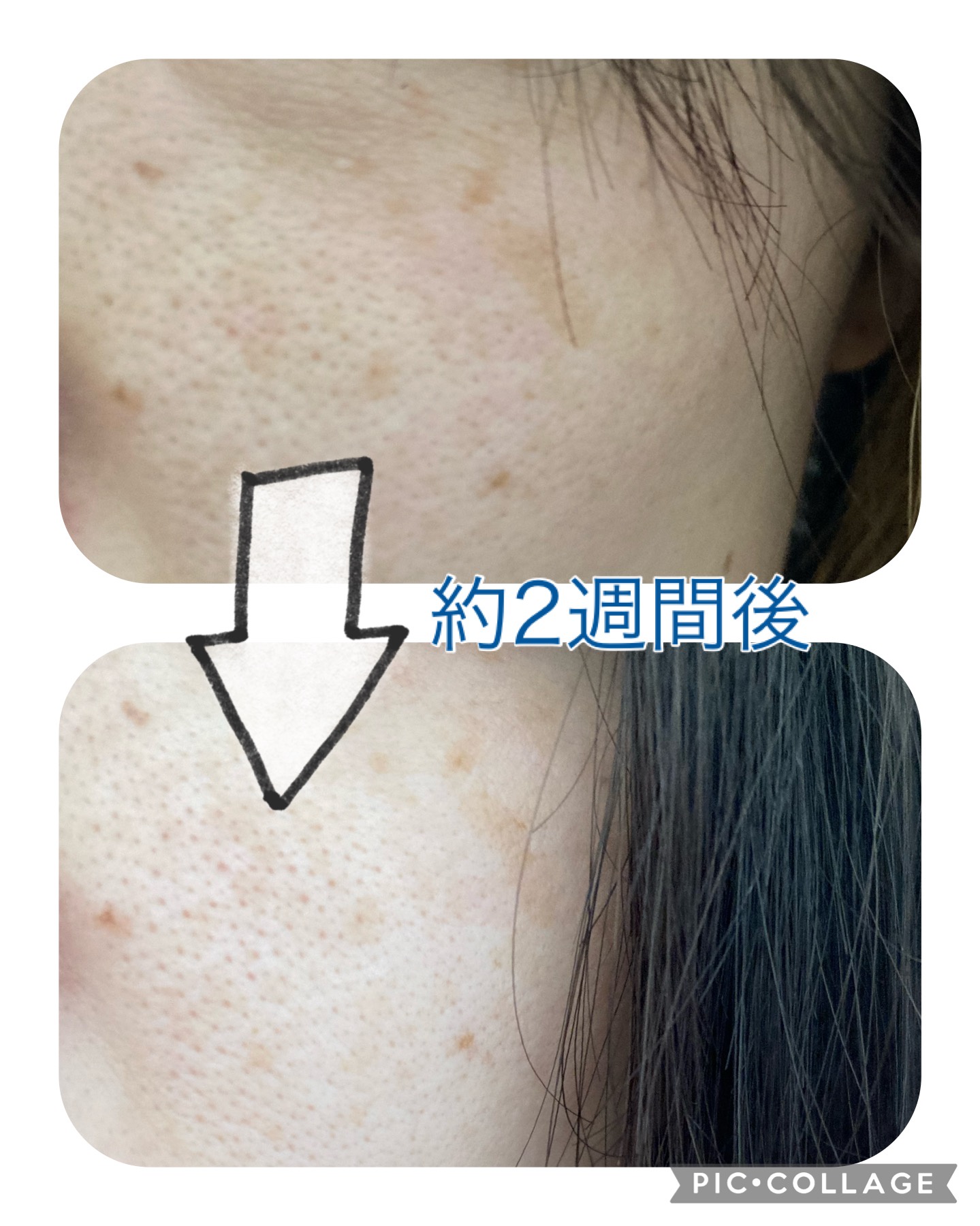 タカミスキンピールの口コミの真相｜毛穴や効果ない噂を徹底検証