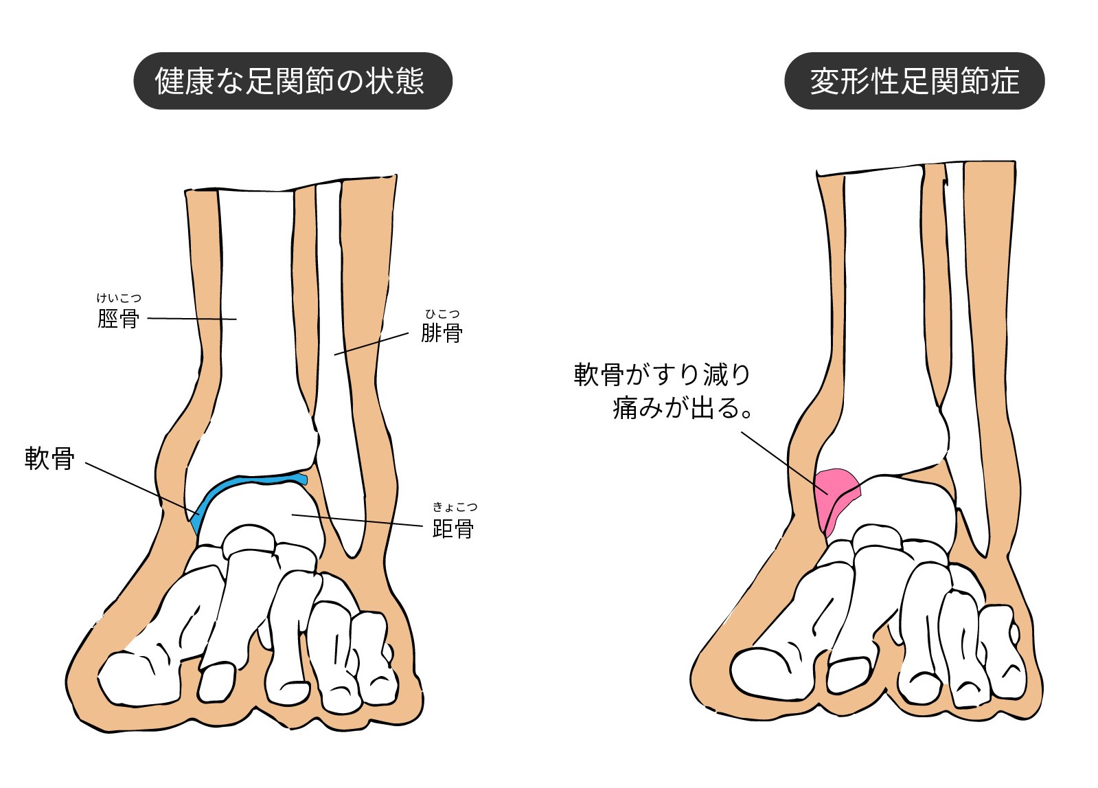 足首の激痛を放置するな！変形性足関節症の初期症状と最新治療
