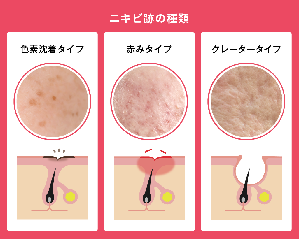 鼻の下のニキビが痛い原因とは？繰り返す赤ニキビの治し方と真相