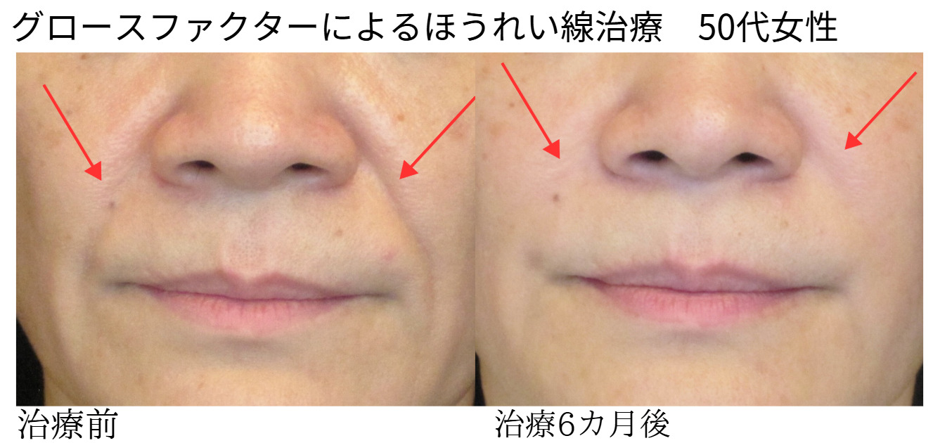 顔筋トレのやりすぎは逆効果？老け見え・シワ悪化を防ぐ新常識