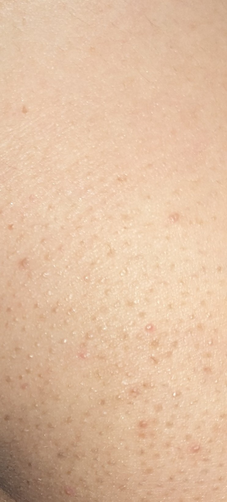 おしりのブツブツが治らない原因は？痛い・かゆい症状の見分け方と治療法