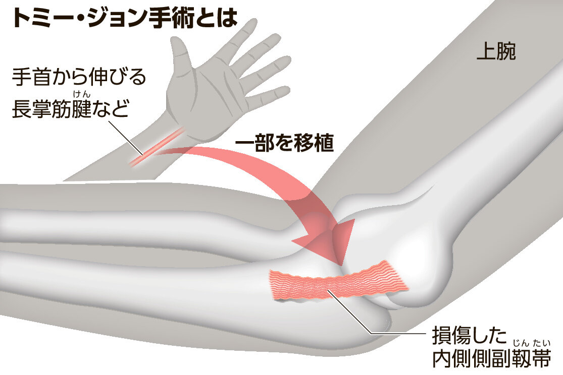 トミージョン手術2回目の復帰率と限界は？大谷翔平ら歴代投手の復活劇