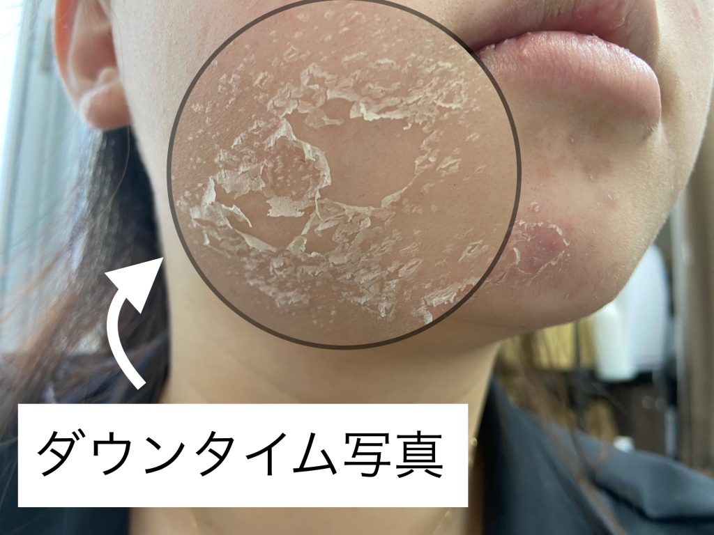 ハーブピーリングのダウンタイム何日？剥離ありなしの経過と失敗回避策