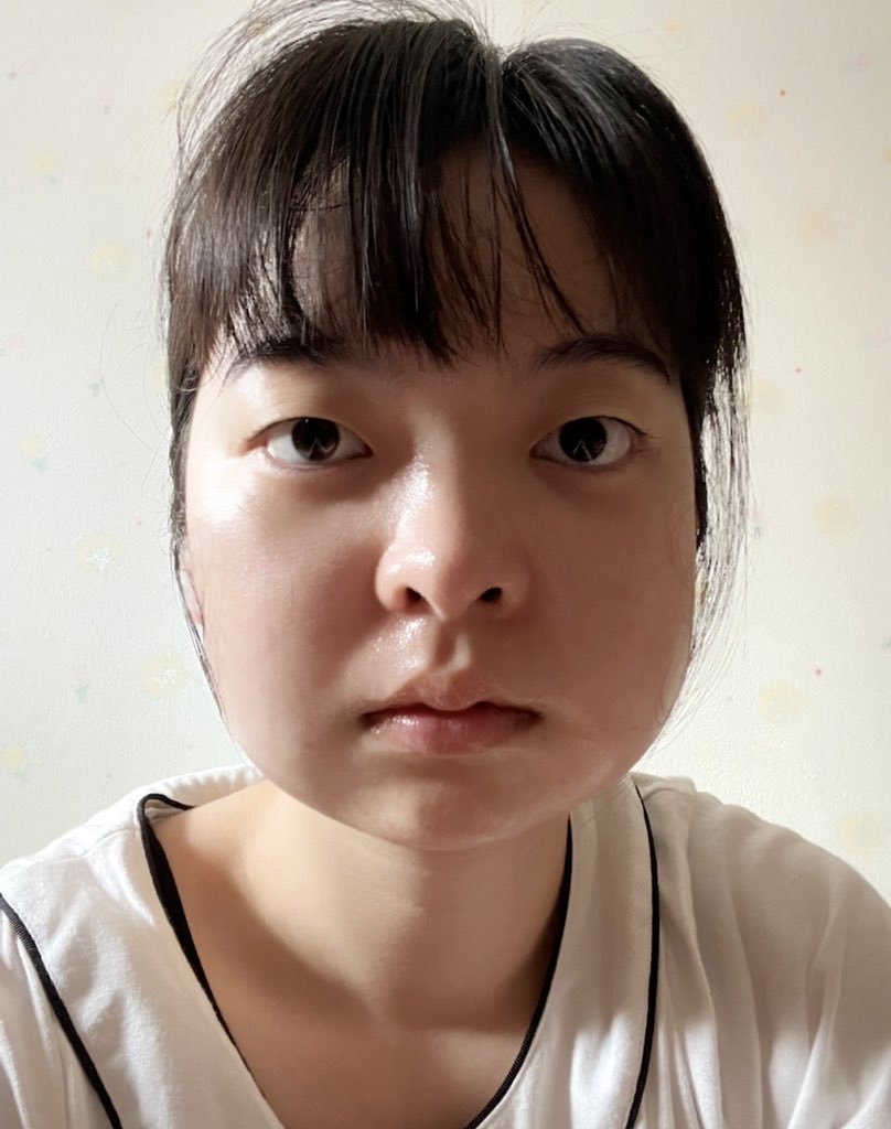親知らず4本同時抜歯の真実！全身麻酔・入院から痛み腫れの限界まで