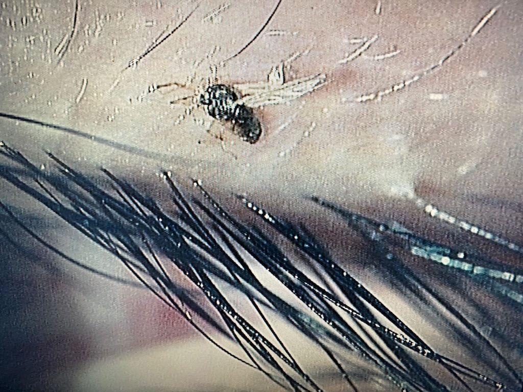 目に虫が入ったら絶対こするな！正しい取り方と感染・寄生虫を防ぐ受診基準