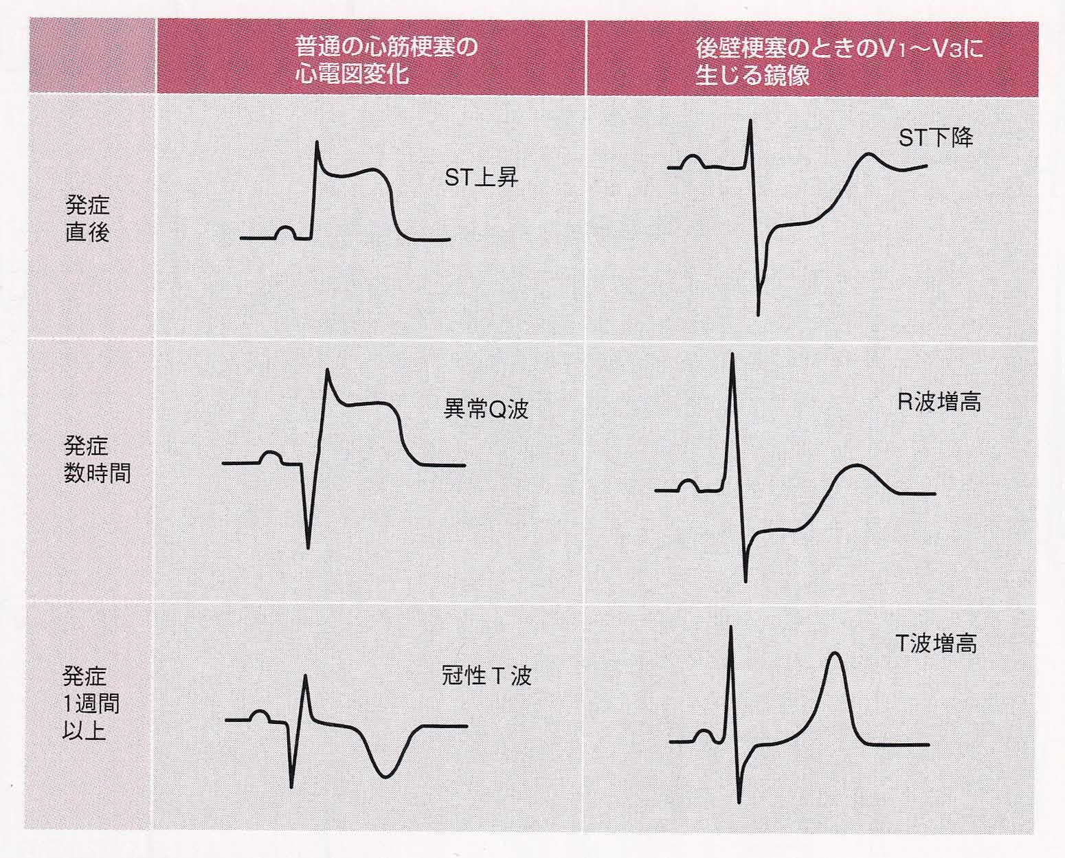 心筋梗塞で心電図のSt上昇が起きる理由とStemiの救命基準
