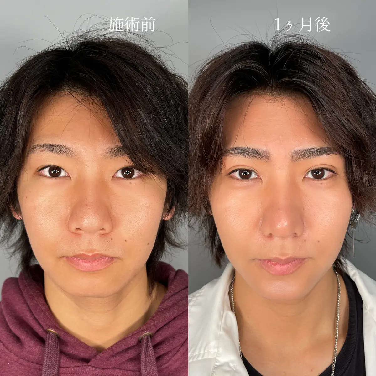 男の二重が気持ち悪いと言われる真相｜不自然な目元の正体と女性の本音