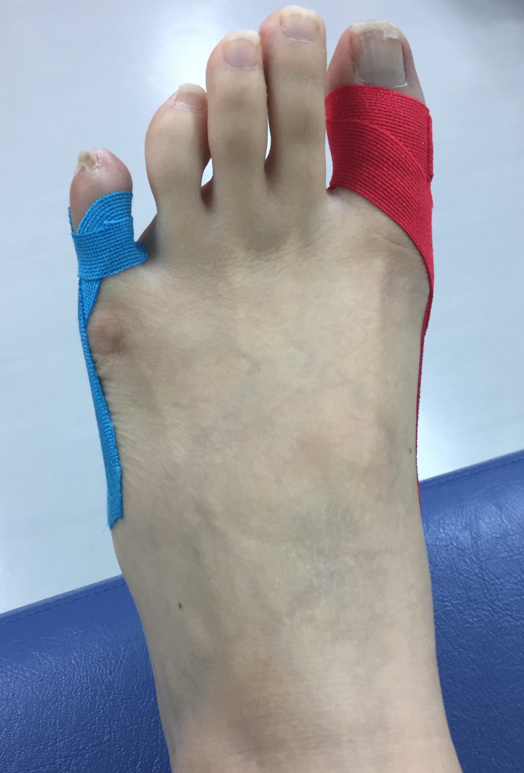 足の小指の寝指はテーピングで治る？正しい巻き方と体の歪みを防ぐ最新改善法