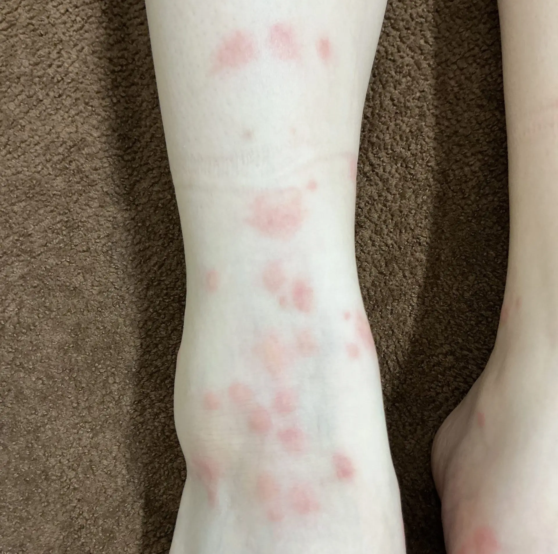 虫刺されでパンパンに腫れる原因と対処法｜危険サインと市販薬の選び方